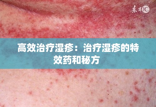 高效治疗湿疹：治疗湿疹的特效药和秘方 